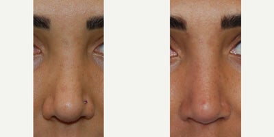 Non-Surgical Rhinoplasty Before & After: Correcting Nostril Retraction, Tip Pinching, and Bridge Irregularities with Permanent M - Our beautiful patient demonstrates the Precision permanence, versatility and safety of microdroplet Silikon-1000 permanent non-surgical revision rhinoplasty treatments. She presented to our office with dissatisfaction of the results of her previous rhinoplasty surgery performed elsewhere. She cited bilateral nostril retraction, pinching of her nasal tip, and over resection of the top of her nasal bridge. Her after photos are one year following two treatments with microdroplet Silikon-1000. You can see a much more natural looking nasal appearance, without the Stigmata of previous rhinoplasty, and without the inconvenience, cost, and uncertainties that are involved with revision surgery. Unlike temporary jail fillers, like HA, Silikon-1000 never leads to necrosis, embolism, blindness, stroke, infection, or biofilm. In fact, medical grade silicone oil has a track record of over 60 years of safety, and predictable results. This technique was taught to me by my rhinoplasty teacher, 27 years ago, and to date, we have had no serious complications.