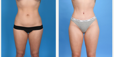 25-34 year old woman treated with Mini Tummy Tuck - Mini/Tiny tummy tuck. Low Bikini incision, VASER liposculpture with abdominal etching and waist contouring, 3 vector corset muscle plication.