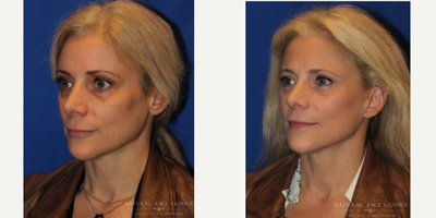 45-54 year old woman treated with Facelift - Patient concerned with saggy skin.