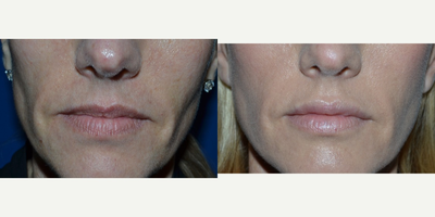 38 year old woman treated with Restylane to her lips - 38 year old active female with thinning lips.  The patient had a Restylane injected to her upper and lower lips.  Note how the pre existing assymmetry upper lip has been corrected.  There is nice natural volume restored.