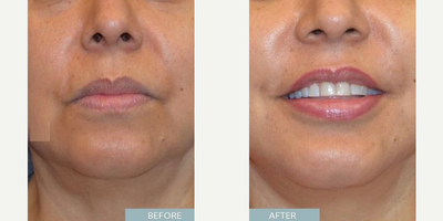 Woman treated with Chin Liposuction - Woman treated with Chin Liposuction