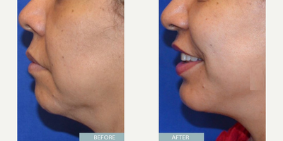Woman treated with Chin Liposuction - Woman treated with Chin Liposuction