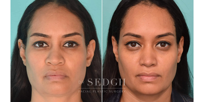 35-44 year old woman treated with African American Rhinoplasty, Rhinoplasty - This is a great example of African-American Rhinoplasty to achieve more definition while maintaining the authenticity of the face. A video clip of her Beautiful and natural result can be found on our Instagram page @drsedgh posted on 4/4/22.