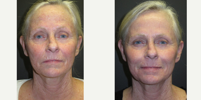 55-64 year old woman treated with Total FX - dyschromia of the face and wrinkled face.  Condition occurred as a result of sun exposure