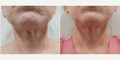 55-64 year old woman treated with Sylfirm X - Patient received 3 sessions of our SylfirmX protocol on face and neck, combined with Benev Exosomes and Alastin Skincare. One month between the 1st and 2nd session and 2 months for the 3rd session. Pictures were taken 2 months after her 3rd session