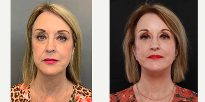 55-64 year old woman treated with Facial - 61 year old female patient had Facelift surgery for overall facial rejuvenation