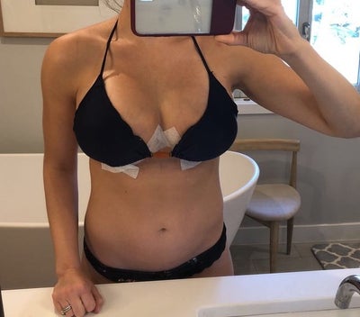 Breast lift with implant 5'8” 145lbs pre surgery size 32d/34c - R