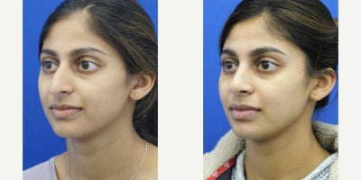 25-34 year old woman treated with Asian Rhinoplasty - She does not desire the typical sloped nose with a supratip break. She wants to maintain her ethnicity and achieve a natural result. Postoperatively at only a few months out her goals are realized.
