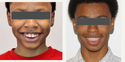 17 or under year old man treated with Braces - A severe anterior dental protrusion was successfully treated with growth modification and braces.