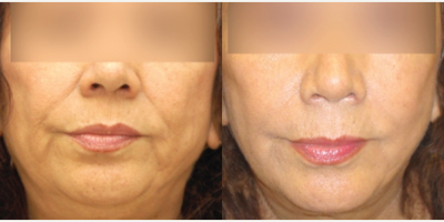 45-54 year old woman treated with MACS Facelift - MACS Facelift