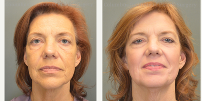 55-64 year old woman treated with Phenol Peel - This lovely Kentucky native wanted her face to match how great she felt inside! She found top-rated plastic surgeon Bivik Shah MD, and made the trip to Columbus to discuss her options. She went forward with his expert advice and scheduled a Phenol Peel. This is a deep chemical peel performed under general anesthesia that provides an overwhelming improvement in wrinkles. Results can last decades! Her amazing result simply cannot be denied. She is shown here before and only 2 months post procedure.