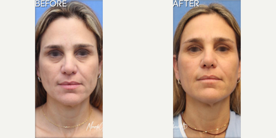 Woman treated with AccuTite - Woman treated with AccuTite for minimally invasive total facial rejuvenation