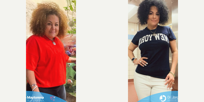 Woman treated with Gastric Sleeve Surgery - Congratulations on this great effort and perseverance to have a healthier life.