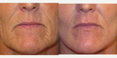 49 year old woman treated with Peri-oral Laser Resurfacing - This middle aged Caucasian female did not like the wrinkly appearance of her mouth. She had Fractional CO2 laser resurfacing around the mouth. Please also know that she had Volbella dermal filler to the wrinkles 1 month after laser to further enhance her appearance. Note the smoother appearance around the mouth and significant improvement of these fine lines.