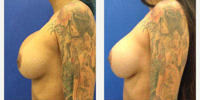 35-44 year old woman treated with Breast Implant Revision - The techniques used in this case included: 1. Removal of the implants2. Removal of all of the scar tissue inside of the breasts (this is called capsulotomy and capsulectomy)3. Inserting a new implant 4. Occasionally, I have to reposition the implant under the chest muscle, if it was placed over the muscle initially. 5. Covering the implant with a sheet of collagen to prevent future capsular contracture. Capsular contracture occurs when the scar tissue around the implant becomes hard and tightens around the implant. 6. I sometimes add a mesh specifically designed for the breast. This acts as an internal bra to hold the breasts up in a higher position and prolongs the longevity of the result. This material is very safe. It is absorbed by the body over time and is replaced with scar tissue which acts as the new internal bra. 7. Many patients also need a mastopexy or breast lift if the breasts are very asymmetric or saggy in appearance. The type of mastopexy depends on the amount of loose skin present. The options include a circumareolar mastopexy (donut lift), vertical mastopexy (lollipop lift) and full mastopexy (anchor scar lift). 8. Lastly, I will occasionally recommend fat grafting to the breasts to fill in areas that need it. Some patients choose to replace their volume with fat instead of an implant. Which steps or techniques are used depends on each patient's specific case. Some patients need only a few of the above steps and some patients require all of the above steps to achieve the best results. The plan is customized for each patient to deliver the best and most beautiful results possible.