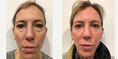 35-44 year old woman treated with Breast Implant Revision - Upper and lower eyelid blepharoplasty