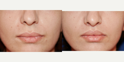 25-34 year old woman treated with Lip Lift - Lip Lift done in office under local anesthesia