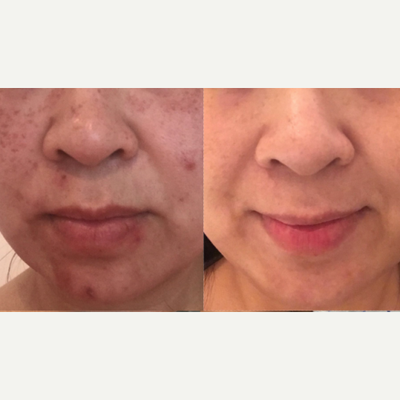 35-44 year old woman treated with Dermapen - 35-44 year old woman treated with Dermapen for acne scarring