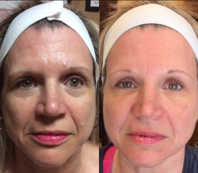 45-54 year old woman treated with Vampire Facelift - Vampire Face Lift improves skin tone, texture, and shape of people's face (male & female).