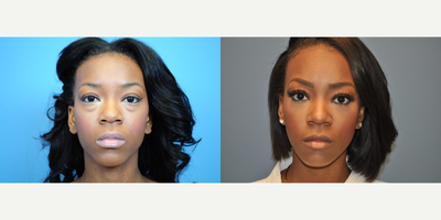 25-34 year old woman treated with Eyelid Surgery - This patient came to the office to discuss a lower eyelid lift.  Even though she is only in her twenties, the bags under her eyes caused her to always look tired and much older than she is.  Dr. Connors performed a lower blepharoplasty to smooth out the area underneath her eyes.