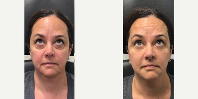 45-54 year old woman treated with PRF Gel Treatment - Patient received an undereye PRF Gel treatment. PRF (Platelet Rich Fibrin) Gel is a natural, regenerative, and volumizing filler that we harvest from your bodys own albumin and platelet rich fibrin from a simple blood draw. This blood-derived gel has a similar consistency as dermal filler and provides powerful skin regeneration and natural volume-boosting.
