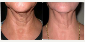 55-64 year old woman treated with Skintyte - Before/After 1 month post 1 treatment