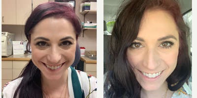 25-34 year old woman treated with Botox - Botox administered by Dr. Schaffer to patients crows feet and lower eyelids.