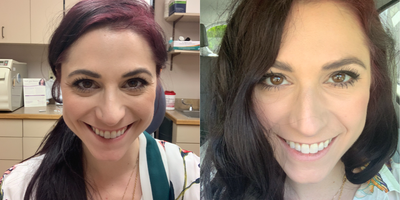 25-34 year old woman treated with Botox - Botox administered by Dr. Eric Schaffer to patients crows feet and lower eyelids.