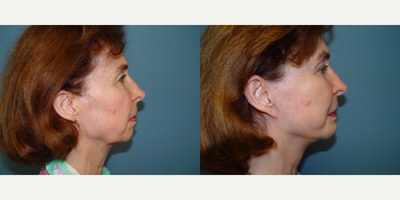 65-74 year old woman treated with Facelift - This woman underwent a facelift and upper and lower blepharoplasty, seen before, and one year after her surgery.