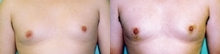 22 year old male patient  - 	22 year-old man with significant inverted nipples. The patient is seen one week post op. Note the temporary bruising, this will be absorbed within 2-3 weeks. The nipples will not invert again. This result is seen at the table as the nipple bud comes out and stays out. The procedure takes about 20 minutes a side.