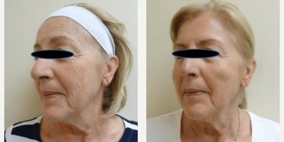 Woman treated with Laser Genesis, Dermal Fillers - Woman treated with Laser Genesis, Dermal Fillers