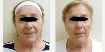 Woman treated with Laser Genesis, Dermal Fillers - Woman treated with Laser Genesis, Dermal Fillers