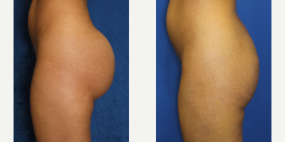 18-24 year old woman treated with Silicone Injection Removal - Introducing our patient, a 23-year-old Hispanic female who stands at 5'3 and weighs 108 pounds. In 2022, she made the unfortunate decision to have raw silicone injected into her buttocks, which resulted in pain and discomfort.	Determined to find a solution, she embarked on a journey from Houston, TX to Beverly Hills, CA in 2023 to seek the expertise of a renowned surgeon. She underwent an ultrasound-guided VASER-assisted procedure to effectively remove the raw silicone from her buttocks with Dr. J. Timothy Katzen.	We are delighted to share that the procedure was successful, and our patient is now experiencing significant relief and improvement. The combination of ultrasound guidance and VASER technology ensured the safe and effective removal of the silicone, allowing her to regain her comfort and well-being.	This case serves as a reminder of the importance of seeking qualified medical professionals for any procedures or treatments. Prioritizing safety and choosing reputable experts can greatly enhance the outcome and minimize the risks associated with cosmetic interventions.	If you or someone you know is grappling with complications from previous procedures, we encourage you to consult with a trusted plastic surgeon who can provide appropriate guidance and solutions tailored to your specific needs. Your health, comfort, and overall satisfaction matter greatly.