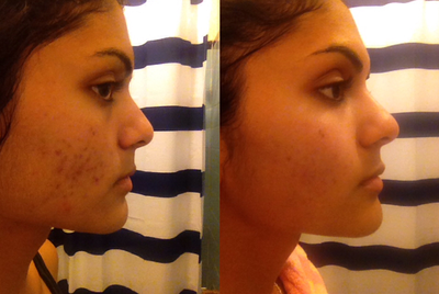 Acne treatment - This 23yo girl came in to my office with concerns of cystic acne, scarring, discoloration, blackheads/whiteheads, and pus bumps. I treated her with a combination of topical retinoids, topical dapsone, antibiotics and spironolactone. Results are 3 months later - no makeup.&nbsp;