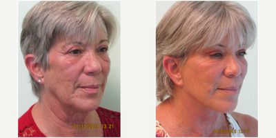 60+ year old woman treated with Facelift under Local Anesthesia - This middle-aged woman presented with the concerns of drooping neck, face, and eyelid skin due to excessive sun exposure over her lifetime.  She additionally had recently lost over 20 pounds and felt her facial and neck skin relax even further.  She was concerned with undergoing deep sedation (ie general or IV anesthesia) for an elective procedure,  so she specifically selected our practice for the purpose of having the procedure performed under local anesthesia.  We elected together to perform a lower facelift, necklift, and upper eyelid lift to address her aging concerns.  All three procedures were performed in 3 hours time under local anesthesia with mild oral sedation with valium.  Her results demonstrate improvement in both the upper and lower face, along with her neck.  Her recovery time was two weeks, at which point she was able to return to full activity and life.