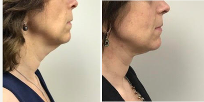 55-64 year old woman treated with Neck Lift - Patient shown before and 2.5 months after a bilateral neck lift done through preauricular (in front and behind the ear) incisions and tightening of the muscle. Contouring the neck and fat removal were done at the same time. All procedures done by Frank J. Ferraro, MD