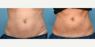45-54 year old woman treated with Cryolipolysis - One session of CoolSculpting at Wise Med Spa was all it took to give this patient the definition she was looking for in her abdomen. Three months post-treatment, she couldn't be happier with her slimmer appearance!
