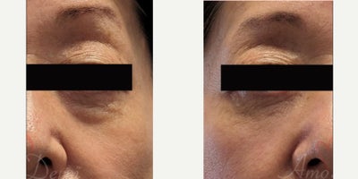 65-74 year old woman treated with Juvederm, Voluma, Volbella - 4D Under Eye Lift - Treatment of dark circles & bags under eyes and cheek restoration with Belotero, Restylane, Volbella and Voluma