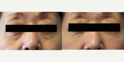 65-74 year old woman treated with Juvederm, Voluma, Volbella - 4D Under Eye Lift - Treatment of dark circles & bags under eyes and cheek restoration with Belotero, Restylane, Volbella and Voluma