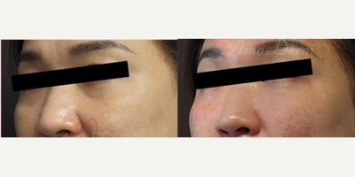45-54 year old woman treated with Juvederm, Voluma, Volbella - 4D Under Eye Lift - Treatment of dark circles & bags under eyes and cheek restoration with Belotero, Restylane, Volbella and Voluma