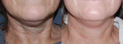 55-64 year old woman treated with Skintyte - 8 months after 6 treatments