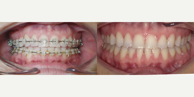 25-34 year old woman treated with Clear Braces - Patient presented to my office after receiving treatment from another orthodontist. Bite closure was challenging, and patient preferred that her bite was corrected without surgery. This result was achieved after re-positioning her braces to correct their alignment. We use Propel to accelerate tooth movement, and used elastics to achieve bite closure and correct her midline.&nbsp;
