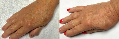 65-74 year old woman treated with eMatrix - Patient had ematrix done on there hand, after 2 weeks the skin is tighter and has lightened spots