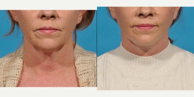 55-64 year old woman treated with Neck Lift, Mini Facelift, Lower Facelift, SMAS Facelift, Deep Plane Facelift - This patient had a necklift to treat jowls, loose skin and muscle in her neck. I did a necklift tightening up the lower SMAS as well. For the necklift I used an incision under the chin to tighten her neck muscle called the platysma. This technique is called a corset platysmaplasty. I also tightened the muscle laterally using a technique called a lateral platysmal window. Extra skin was removed using incision behind her ears and in her posterior hairline.