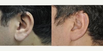 42 Year Old Male 10 Months After Earlobe Reduction - This 42 year old male is shown 11 months after reduction of both earlobes. The 1 hour procedure was performed very comfortably under local anesthesia in the office procedure room.