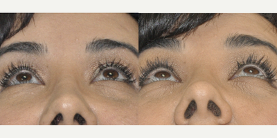 35 year old female after 2 months of using Latisse - This 35 year old female was desiring longer and thicker upper eyelashes and was interested in Latisse. After 2 months of treatment, she is already noticing darker, longer, and thicker eyelashes, and the results are expected to continue to improve until 3 to 4 months after which time she will continue maintenance treatment.