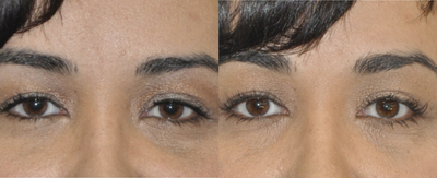 35 year old female after 2 months of using Latisse - 	This 35 year old female was desiring longer and thicker upper eyelashes and was interested in Latisse. After 2 months of treatment, she is already noticing darker, longer, and thicker eyelashes, and the results are expected to continue to improve until 3 to 4 months after which time she will continue maintenance treatment.