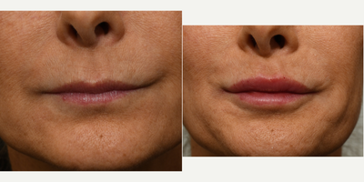 45-54 year old woman treated with Lip Fillers, Restylane, Restylane Kysse, Dermal Fillers - This patient underwent a lip augmentation utilizing 1cc of Restylane Kysse. Notice how we were able to bring out the left oral commissure due to it being pulled back further compared to the right side. We were also able to symmetrize the patient's lips so when their face is at rest their mouth isn't crooked.