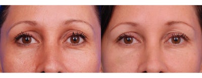 Belotero lower eyelid - 42 year old woman who wanted to soften the lower lid and tear trough hollow.
