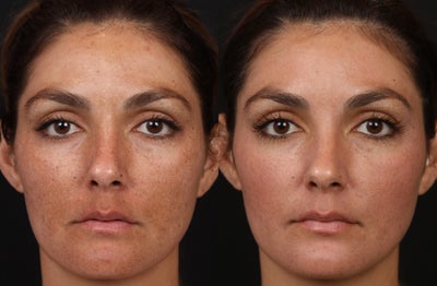 Cosmelan for Melasma - Patient was treated with Cosmelan MD (Hydroquinone) for her melasma.